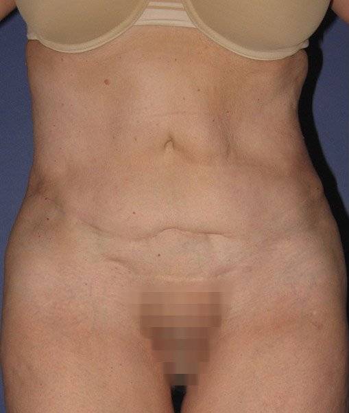 before abdominoplasty front view of female patient 436 at Paydar Plastic Surgery