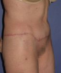 Patient Tummy Tuck Revision Thumbnail After 1