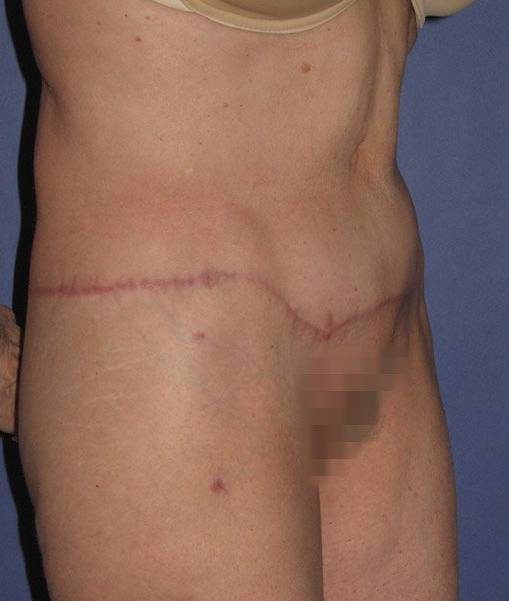 after abdominoplasty right angle view of female patient 436 at Paydar Plastic Surgery