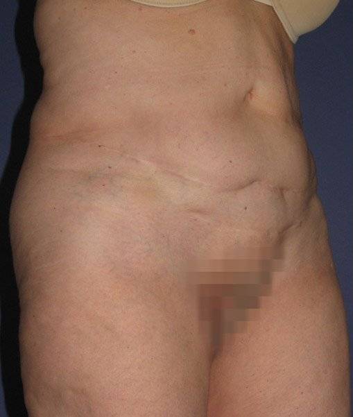 Patient Tummy Tuck Revision Before 1