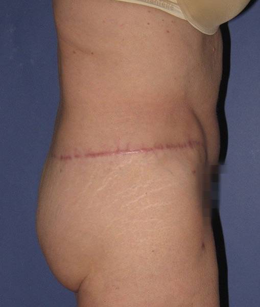 Patient Tummy Tuck Revision Before 2