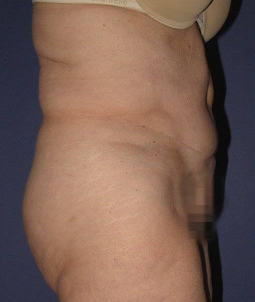 before abdominoplasty right side view of female patient 436 at Paydar Plastic Surgery