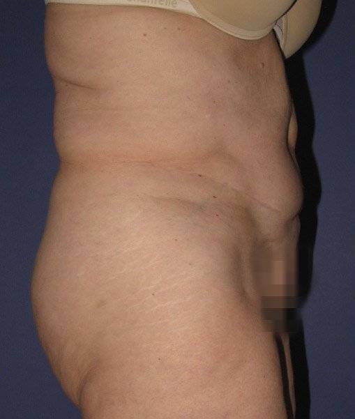 Patient Tummy Tuck Revision Before 2