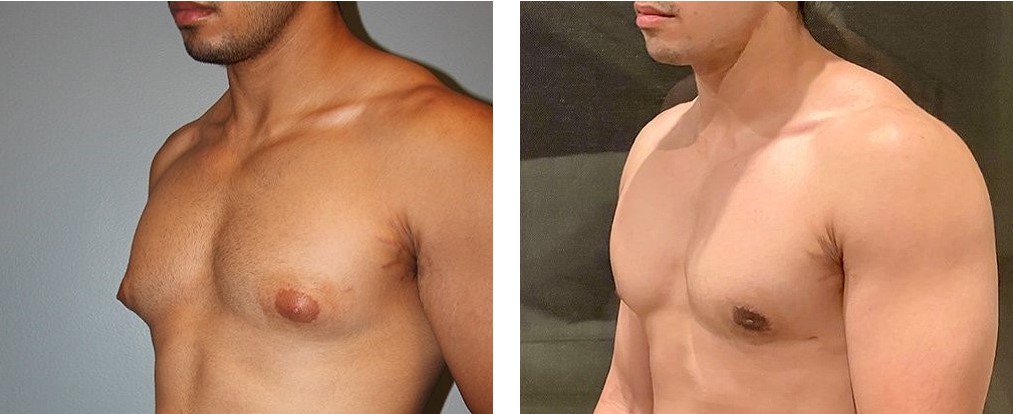 before and after gynecomastia diagonal view