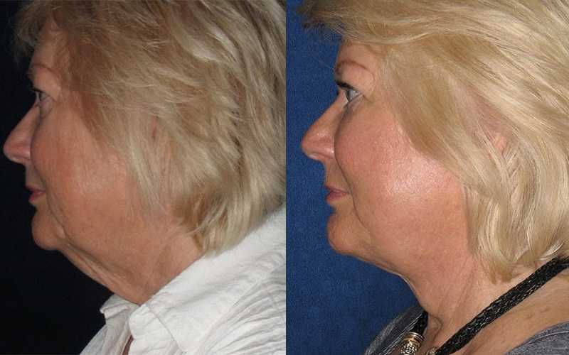 before and after neck lift side profile view