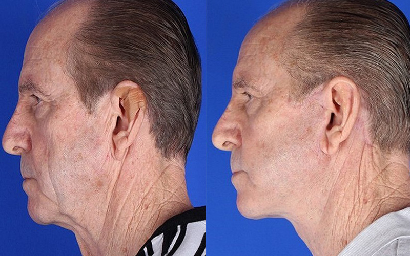 before and after neck lift side profile view