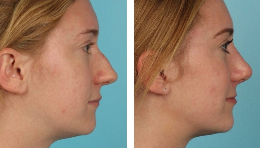 before and after rhinoplasty female patient side profile