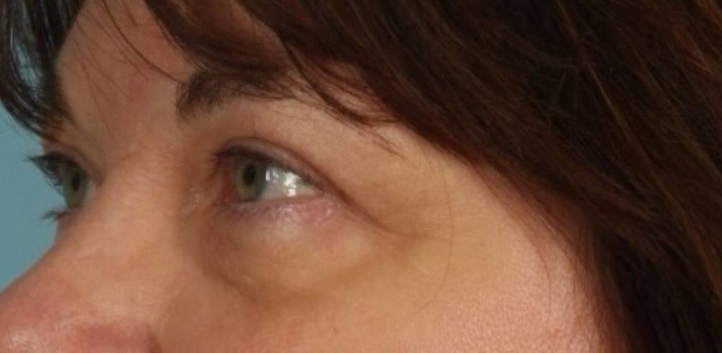 before blepharoplasty female patient zoomed side profile