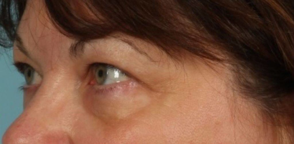 after blepharoplasty female patient zoomed side profile