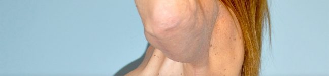 after Brachioplasty / Arm Lift side view Case 3356