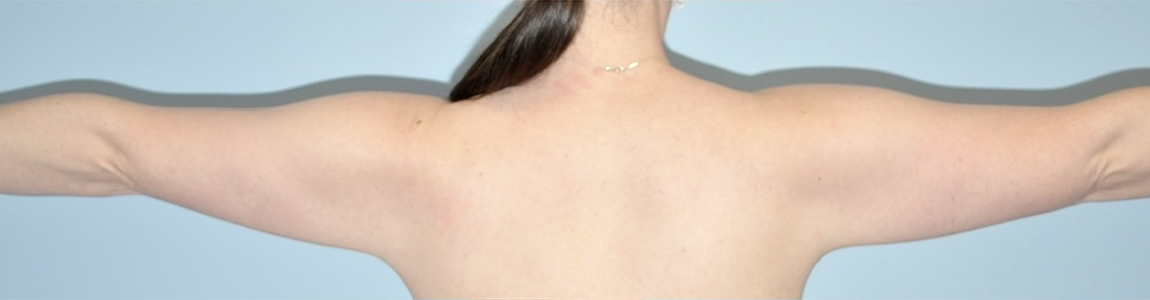 before Brachioplasty / Arm Lift Case female patient back view 3673