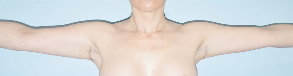 after Brachioplasty / Arm Lift Case female patient front view 3673