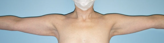 before Brachioplasty / Arm Lift Case female patient front view 3673