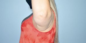 Patient Brachioplasty | Arm Lift Thumbnail Before 2