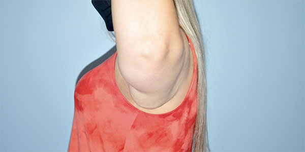 Patient Brachioplasty | Arm Lift Before 2