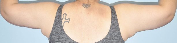 Patient Brachioplasty | Arm Lift Thumbnail After 1