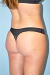 after brazilian butt lift angle view case 3789