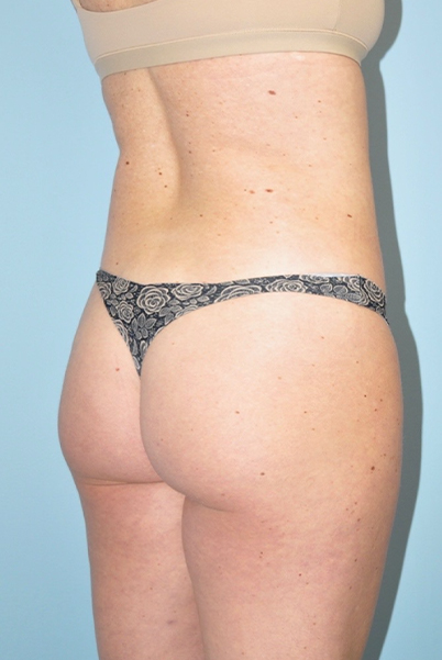 before brazilian butt lift angle view case 3789