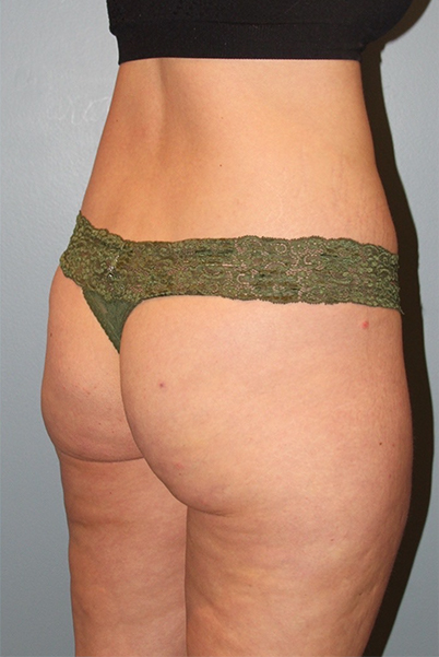 before brazilian butt lift angle view case 3796