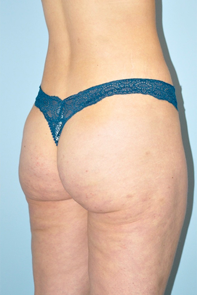 after brazilian butt lift angle view case 3796