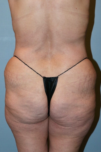 Patient Brazilian Butt Lift Before 1