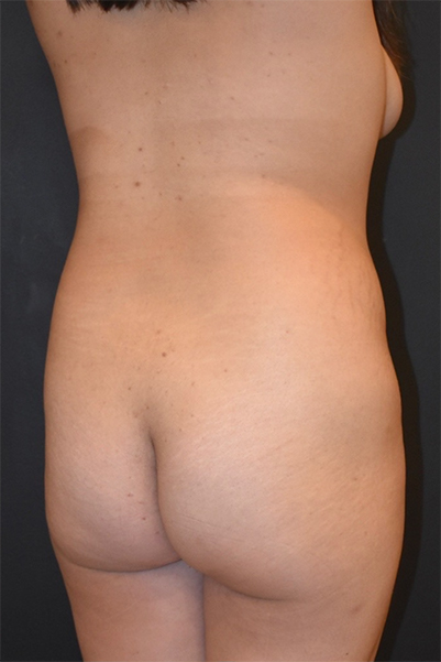 before brazilian butt lift angle view case 3808