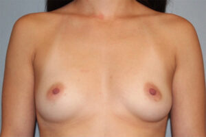 before Breast Augmentation front angle view Case 3460