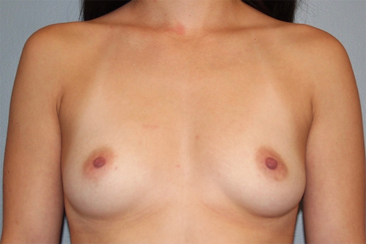 before Breast Augmentation front angle view Case 3460