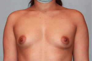 before Breast Augmentation front angle view Case 3467