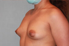 before Breast Augmentation diagonal angle view Case 3467