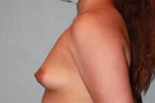 before Breast Augmentation side angle view Case 3467
