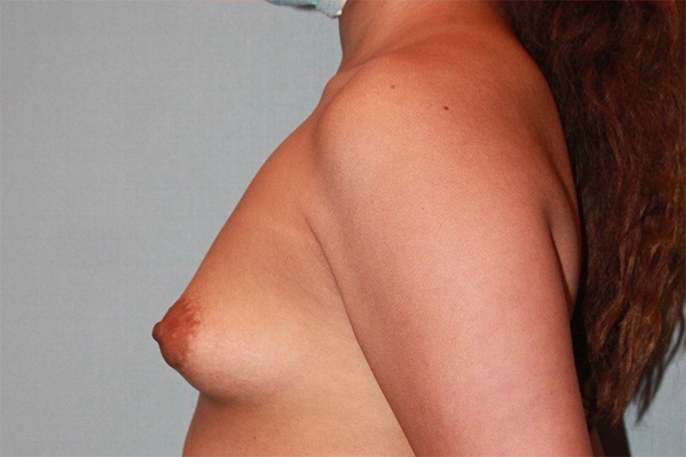 Patient Breast Augmentation Before 2