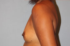 Patient Breast Augmentation Thumbnail Before 2