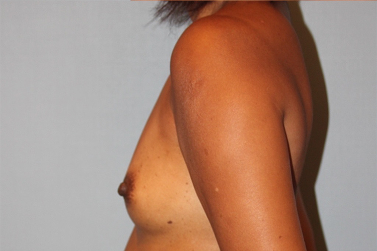 before breast augmentation side view case 3474