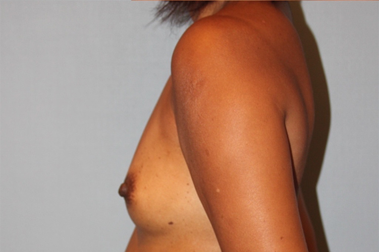 Patient Breast Augmentation Before 2