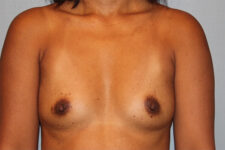 before breast augmentation front view case 3474