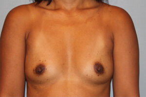Patient Breast Augmentation Before 0