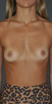 before breast augmentation front view case 3481
