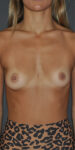 Patient Breast Augmentation Thumbnail Before 2