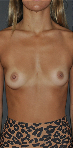 before breast augmentation front view case 3481