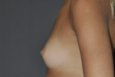 Patient Breast Augmentation Thumbnail Before 1