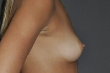 Patient Breast Augmentation Thumbnail Before 0