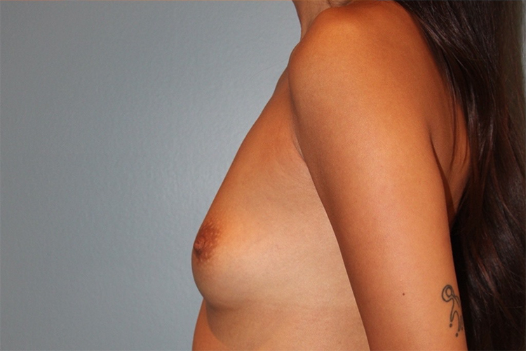 before breast augmentation side view case 3500