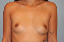 Patient Breast Augmentation Thumbnail Before 0