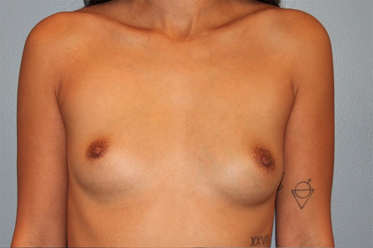 Patient Breast Augmentation Before 0