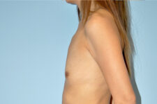 Patient Breast Augmentation Thumbnail Before 2