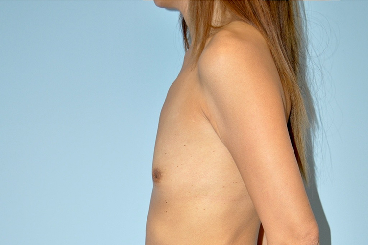 Patient Breast Augmentation Before 2