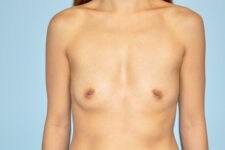 before breast augmentation front view case 3514