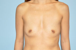 before breast augmentation front view case 3514