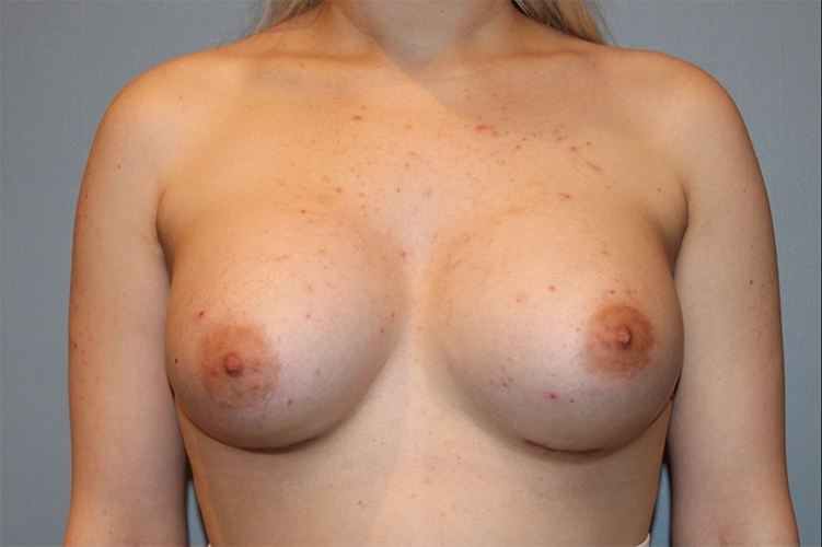 Patient Breast Augmentation Before 0